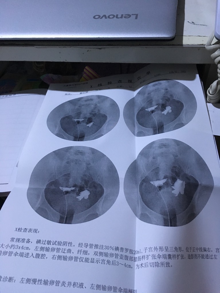 为什么输卵管会粘连,为什么输卵管粘连不能结扎